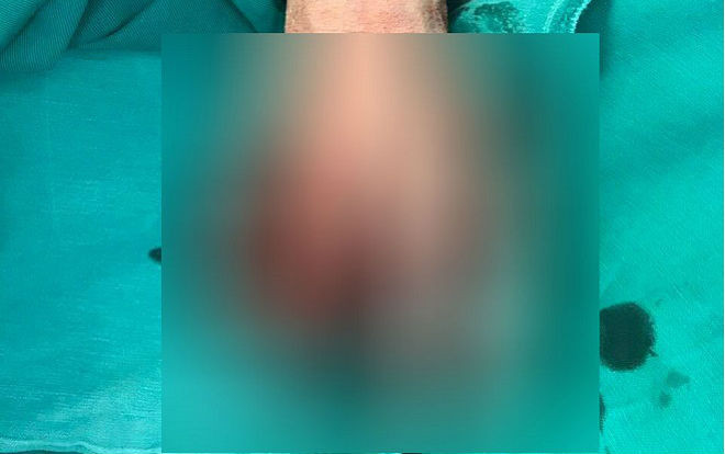 Điện thoại iPhone phát nổ khi đang sạc pin, bé trai 13 tuổi dập nát bàn tay Ảnh 2