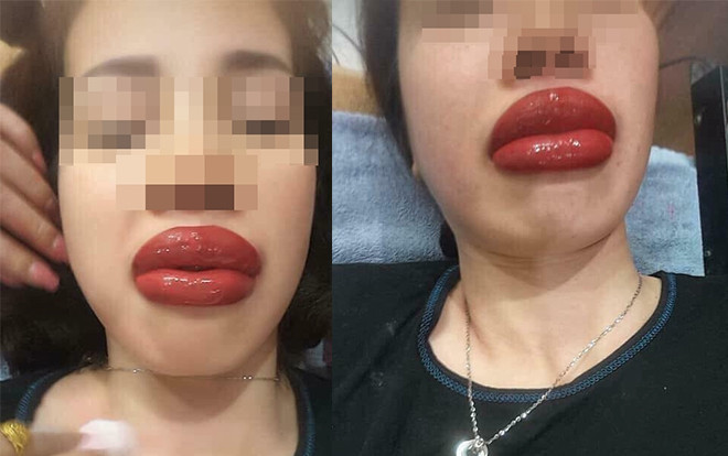Đôi môi như muốn nổ tung của cô gái xăm môi mọng mà nhận về cái kết đắng Ảnh 2