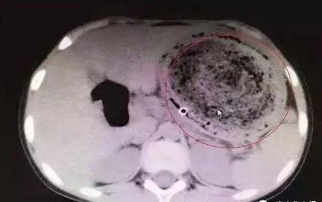 Búi tóc khổng lồ nặng 1,5 kg trong bụng bé gái sau 6 năm nghiện nhai tóc Ảnh 2