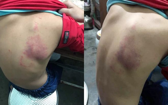 Tạm đình chỉ chủ nhiệm lớp cô giáo nghi dùng thước đánh nam sinh lớp 2 bầm tím bả vai Ảnh 2
