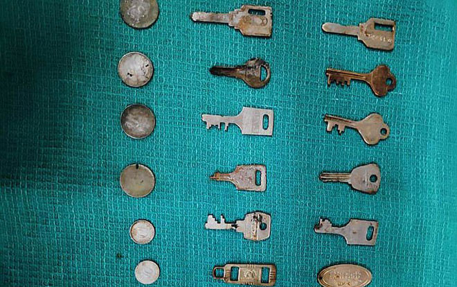 Người đàn ông kêu đau bụng, bác sĩ điếng người khi nhìn thấy những thứ này bên trong Ảnh 2