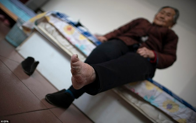 Đôi chân biến dạng cả đời của người phụ nữ cuối cùng theo tục 'bó chân gót sen' ở Trung Quốc Ảnh 2