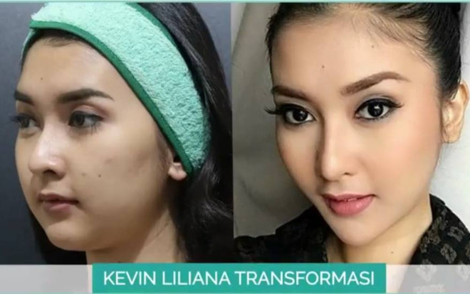 Loạt hoa hậu đình đám Indonesia bị lộ ảnh 'đập mặt xây lại' gây rúng động cộng đồng yêu sắc đẹp Ảnh 2