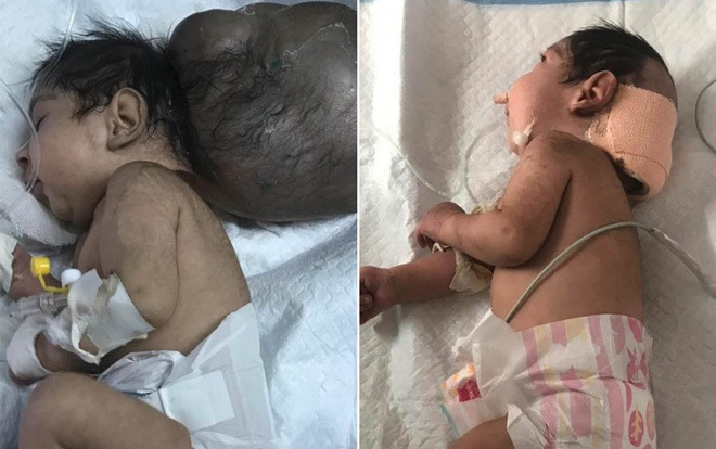 Giải cứu bé sơ sinh '2 đầu' sau khi bị chính cha ruột chôn sống Ảnh 2