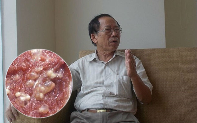 Chuyên gia lý giải vì sao sán lợn có thể lây sang người dù đã qua chế biến Ảnh 2