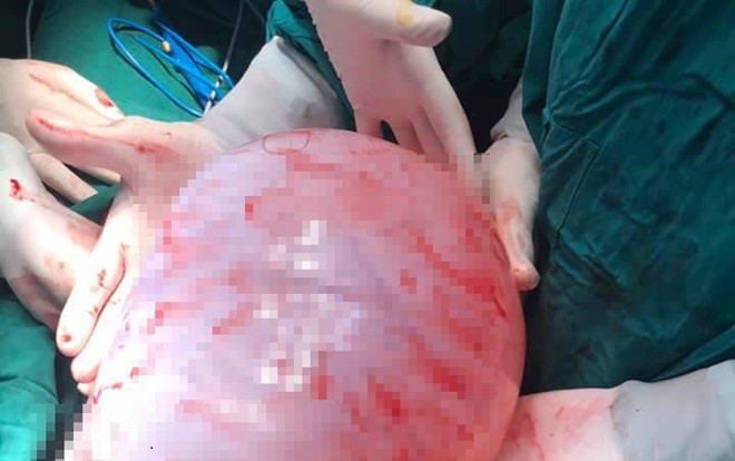 Cô gái suýt mất mạng vì 'đốt ngải' chữa u nang buồng trứng Ảnh 2