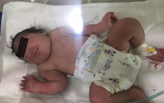 Xót xa em bé sinh ra không có mũi, chỉ có thể thở bằng miệng Ảnh 2