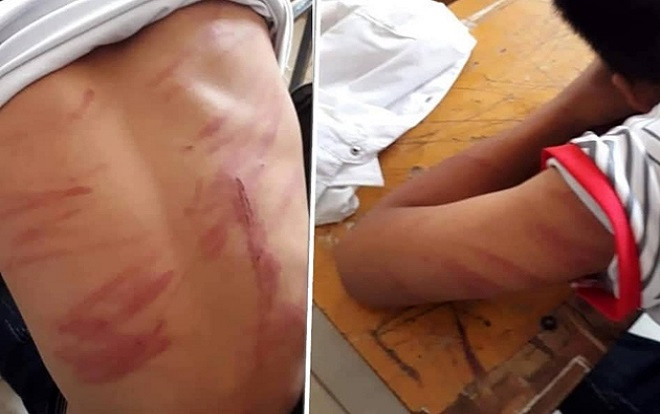 Nam sinh ngất xỉu ở lớp vì bị bố ruột bạo hành dã man Ảnh 2