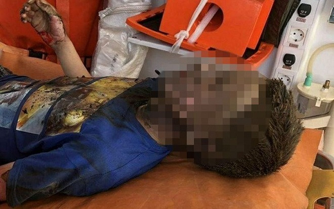 Chạm phải dòng điện 10.000 vôn, cậu bé thoát chết thần kỳ Ảnh 2