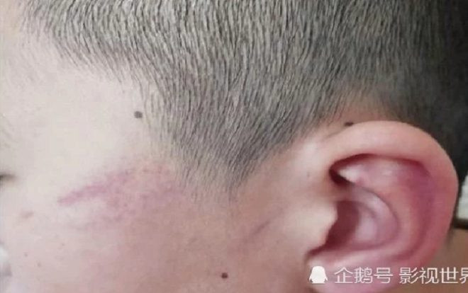 Không trả lời được câu hỏi, học sinh bị giáo viên tát gần 100 cái vào mặt tới mức nhập viện Ảnh 2