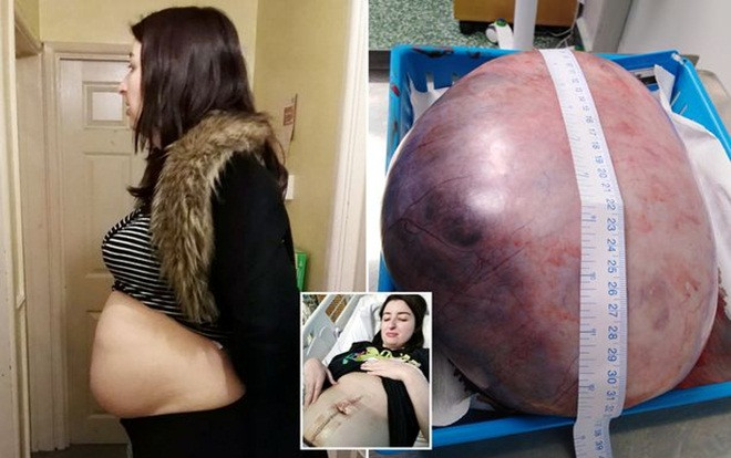 Bụng to như đang mang bầu, cô gái làm bác sĩ tá hỏa khi phát hiện thứ bên trong Ảnh 2