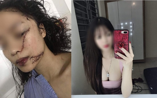Thiếu nữ xinh đẹp bị rạch mặt, cổ và tay, phải khâu 60 mũi: Nghi vấn bị bạn thân dụ tới phòng? Ảnh 2