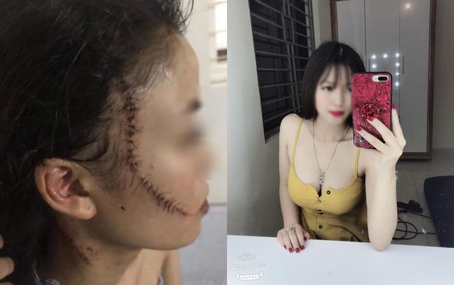 Vụ thiếu nữ bị bạn cũ rạch mặt, khâu 60 mũi: Nạn nhân là người ra tay trước Ảnh 2