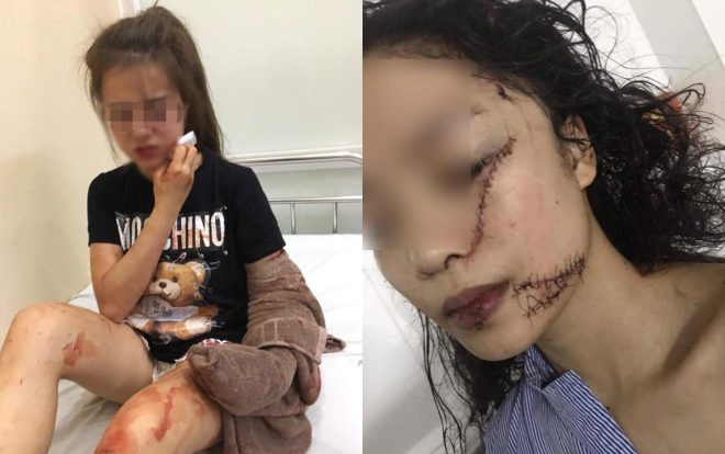 Cô gái rạch mặt bạn cũ, khiến khâu 60 mũi: ‘Q. cầm dao đâm trước làm tôi hoảng loạn, không giữ được bình tĩnh’ Ảnh 2