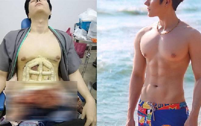 Trai đẹp chấp nhận đau đớn phẫu thuật thẩm mỹ 'nâng cấp cơ bụng' và kết quả bất ngờ Ảnh 2