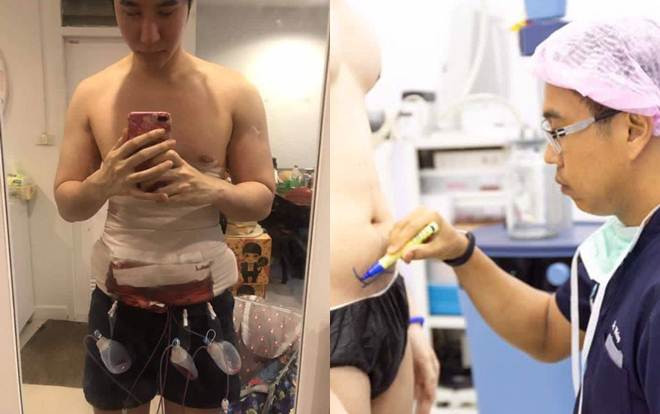 Công khai hình ảnh phẫu thuật thẩm mỹ bụng 6 múi, chàng trai khiến nhiều người rùng mình Ảnh 2