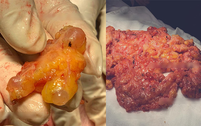 Rùng mình vì silicon vón cục như hạt trân châu trong ngực cô gái Việt sau 8 năm dao kéo vòng 1 Ảnh 2