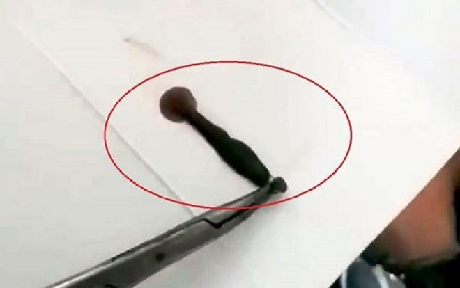 Nghệ An: Đi tắm suối, người đàn ông bị đỉa chui vào mũi sống Ảnh 2