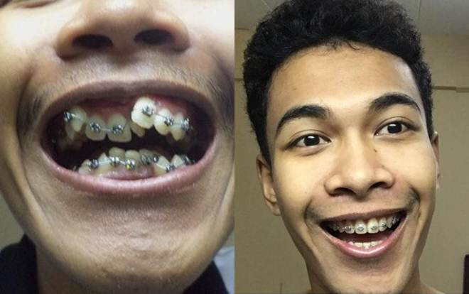 Nhờ niềng răng, nam thanh niên bị kì thị vì hàm răng khập khiễng được đổi đời Ảnh 2