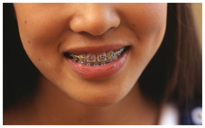Niềng răng: Phép thần giúp cả triệu cô gái lột xác mà không cần phẫu thuật thẩm mỹ Ảnh 2
