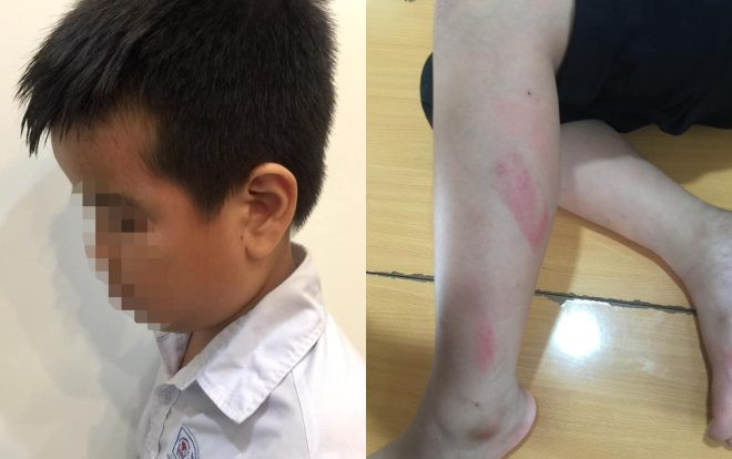 Đánh tấy đỏ ở chân, vùng mặt nam sinh lớp 2 trong giờ kiểm tra học kỳ, nữ giáo viên bị tạm đình chỉ công tác Ảnh 2