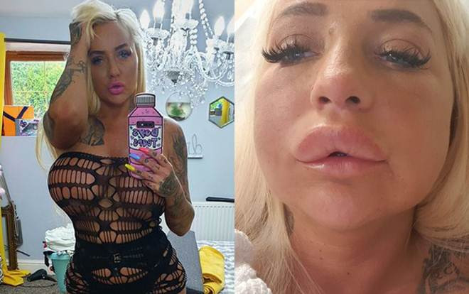 Ngôi sao phim người lớn tiêm chất làm tan filler, môi sưng gấp 4 lần bình thường Ảnh 2