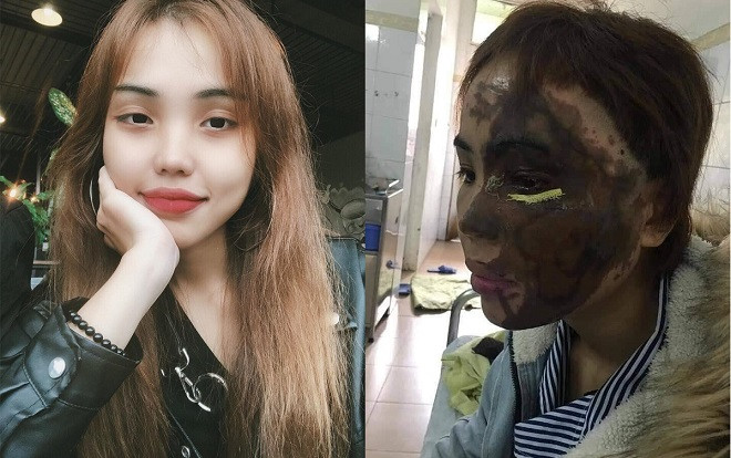 Đà Nẵng: Thiếu úy Công an tạt axit hủy hoại khuôn mặt vợ sắp cưới do ghen tuông Ảnh 2