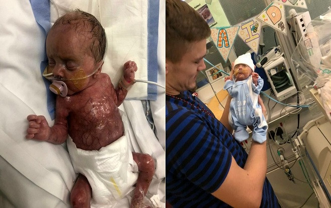 Sinh ra không có da, em bé sống sót thần kỳ Ảnh 2