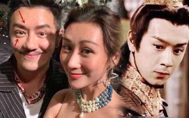 Xuất hiện với diện mạo bọng mắt sưng, đầu mũi to, Trần Hạo Dân phẫu thuật thẩm mỹ thất bại? Ảnh 2