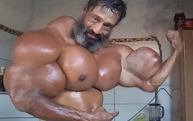 Cơ bắp cuồn cuộn đến kinh dị của người đàn ông nghiện tiêm hỗn hợp dầu Ảnh 2