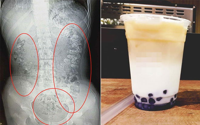 Cô gái tá hỏa khi thấy những chấm tròn trong bụng, nguyên nhân là thứ mà giới trẻ ai cũng mê Ảnh 2