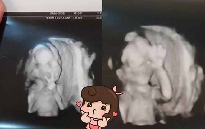Giơ tay chào đủ kiểu khi chụp ảnh siêu âm, em bé 'nổi như cồn' trên MXH ngay từ trong trứng nước Ảnh 2