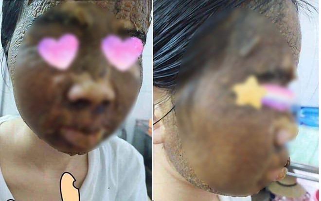 Chết khiếp với bức hình cô gái đắp mặt nạ rượu thuốc được tung hô như tiên dược Ảnh 2