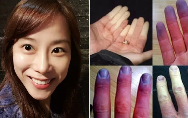 Cựu thành viên nhóm Jewerlry mắc hội chứng Raunaud Ảnh 2