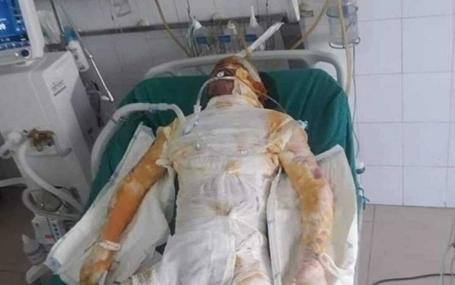 Sụt lò luyện gang tại Hải Dương, nhiều công nhân bị bỏng nặng Ảnh 2