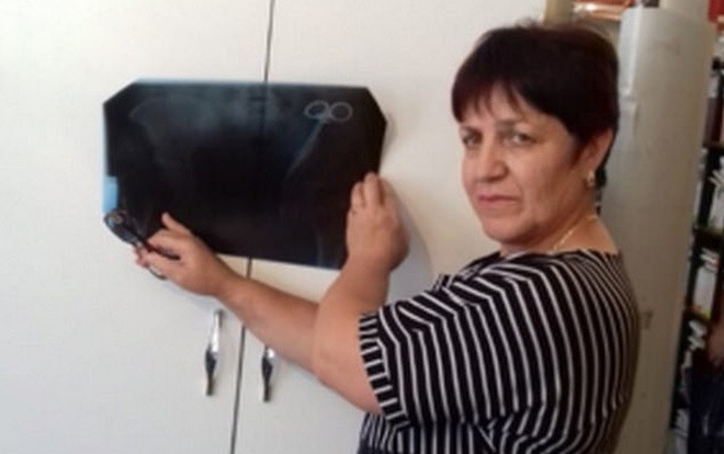 Người phụ nữ ngã ngửa khi phát hiện kẹp phẫu thuật bị bỏ quên 23 năm trong bụng Ảnh 2