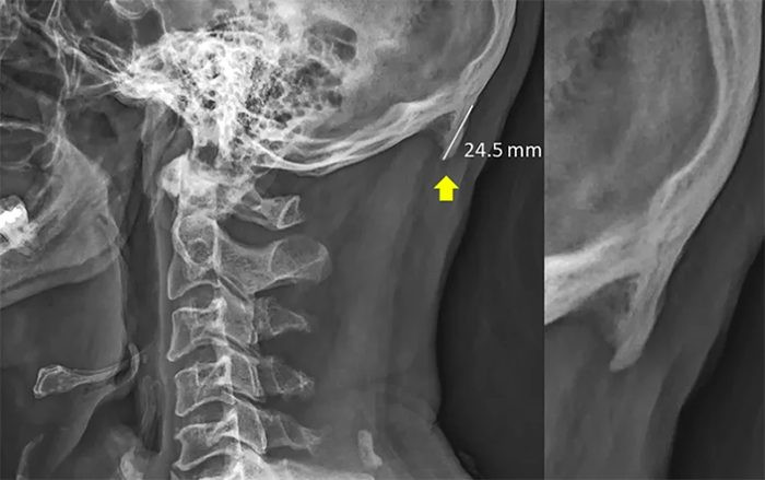 Dùng điện thoại nhiều có thể khiến người trẻ bị 'mọc sừng' Ảnh 2