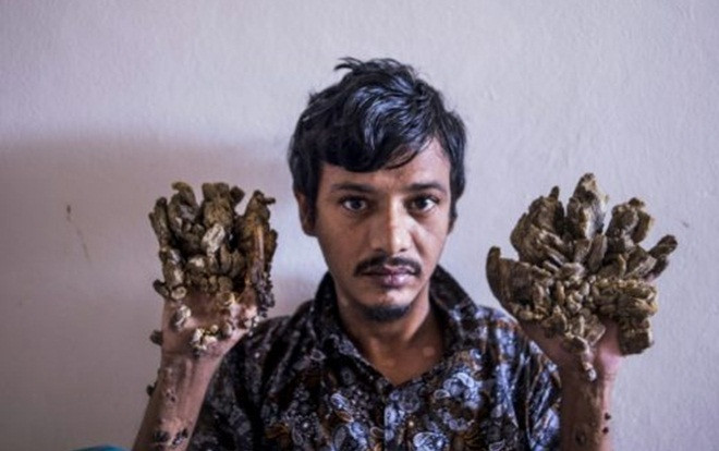 Sau 25 lần phẫu thuật, 'người cây' cầu xin bác sĩ cắt cụt tay vì không thể chịu nổi đau đớn Ảnh 2