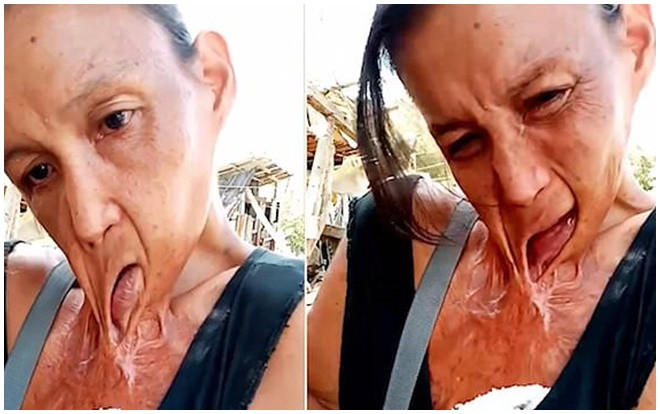 Người phụ nữ khốn khổ với đôi môi dính chặt ngực suốt 15 năm Ảnh 2