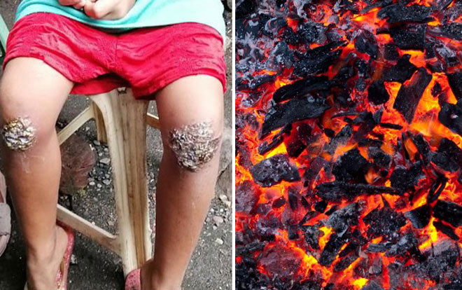 Quên mang cặp sách về nhà, bé gái 8 tuổi bị mẹ phạt quỳ trên than hồng Ảnh 2