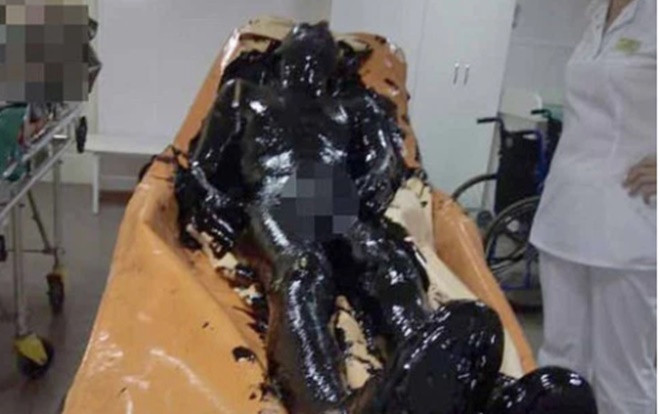 Ngạt thở khi rơi vào hố nhựa đường đặc quánh, người đàn ông may mắn sống sót Ảnh 2