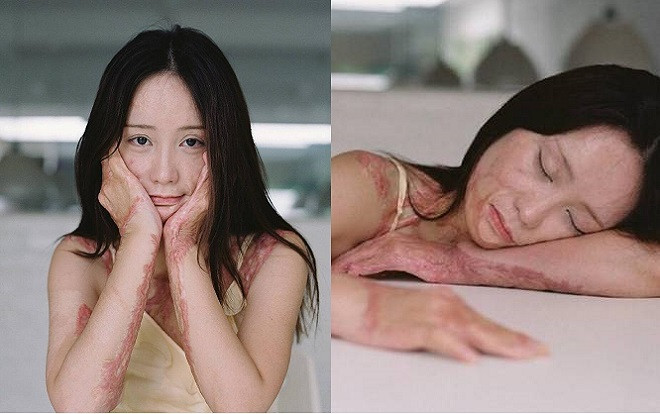 Xót xa với loạt ảnh cơ thể chằng chịt sẹo của nữ sinh bị nam sinh cùng lớp phá hủy dung nhan chỉ vì… cuồng yêu Ảnh 2