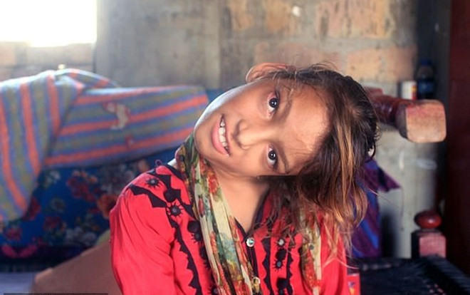 Bé gái 10 năm sống vật lộn với chiếc cổ vẹo 90 độ, không thể tự mình chải tóc hay đi lại Ảnh 2