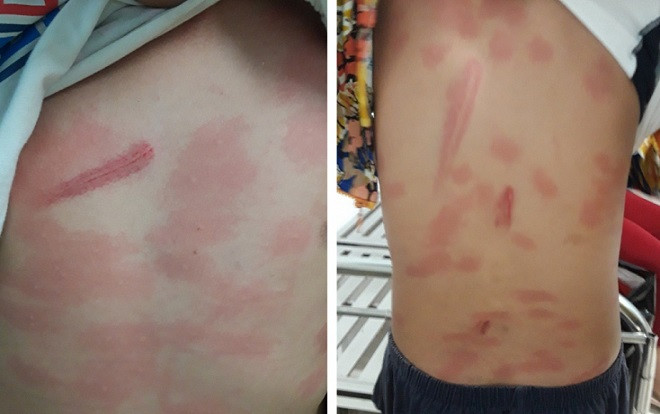 Bé trai 13 tuổi bị cô ruột dùng gậy đánh liên tiếp vào ngực và lưng dã man phải nhập viện Ảnh 2