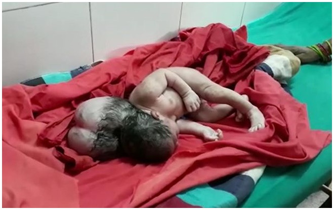 Bé gái sơ sinh chào đời với '3 đầu' như người ngoài hành tinh do dị tật hiếm gặp Ảnh 2