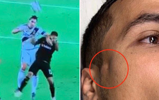 Rợn người cảnh xương sọ nứt toác của cầu thủ bị Ibrahimovic thúc cùi chỏ Ảnh 2