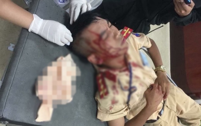 Vợ vi phạm giao thông vì chở 3 không đội mũ bảo hiểm, chồng cầm đá tấn công đại uý CSGT nhập viện Ảnh 2