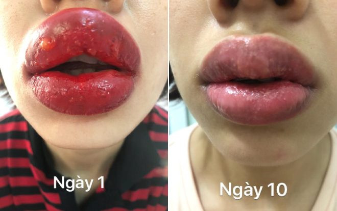 Cô gái rớt nước mắt vì môi bị sưng tều, nổi mụn nước sau khi xăm môi ở spa gần nhà Ảnh 2