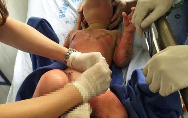 Vụ 3 trẻ mầm non bị bỏng khi học kỹ năng tại trường: Các bé bỏng rất nặng, bác sĩ chưa thể tiên lượng Ảnh 2