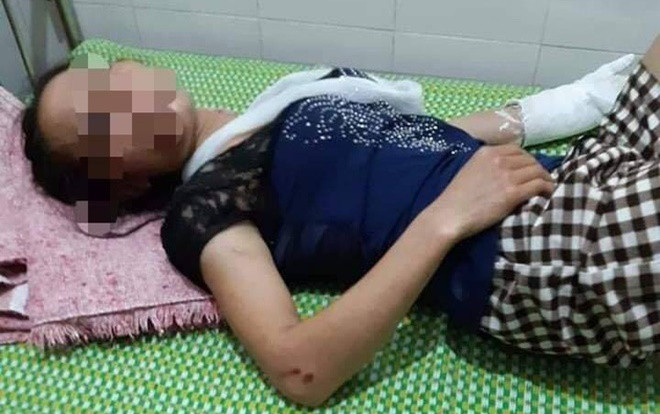 Điều tra vụ vợ bị chồng đánh gãy tay cùng nhiều vết thâm tím trên người Ảnh 2